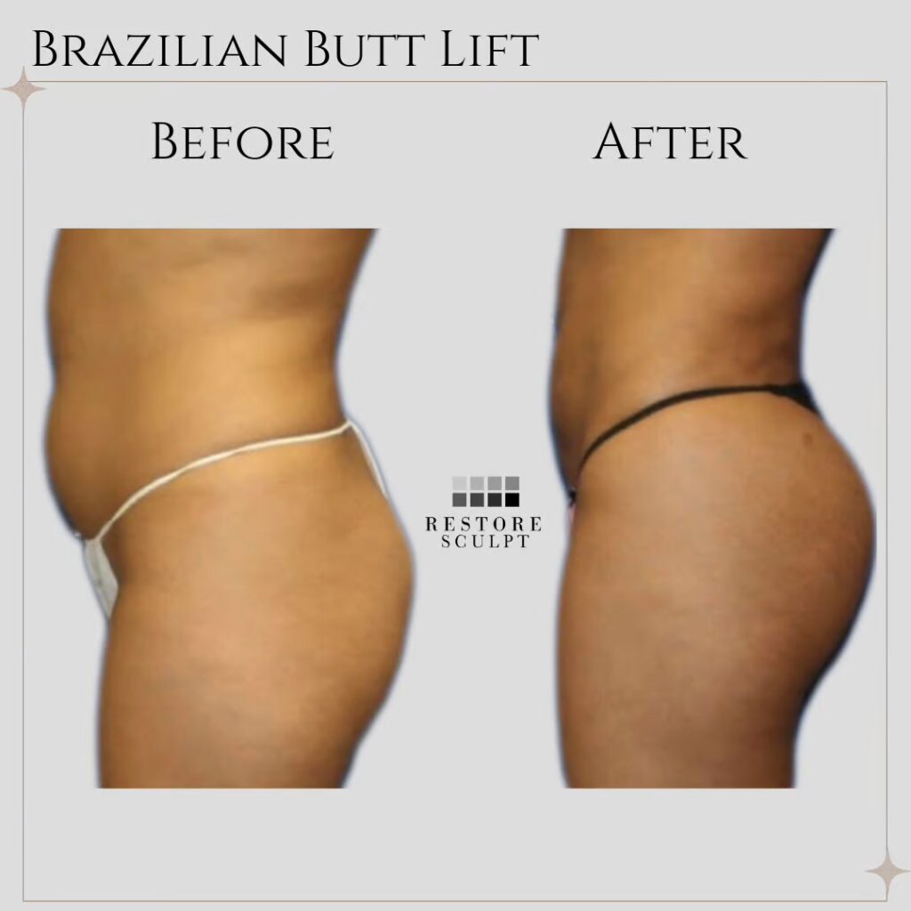 Brazilian butt lift before and after, side view, with more buttock projection in the after photo