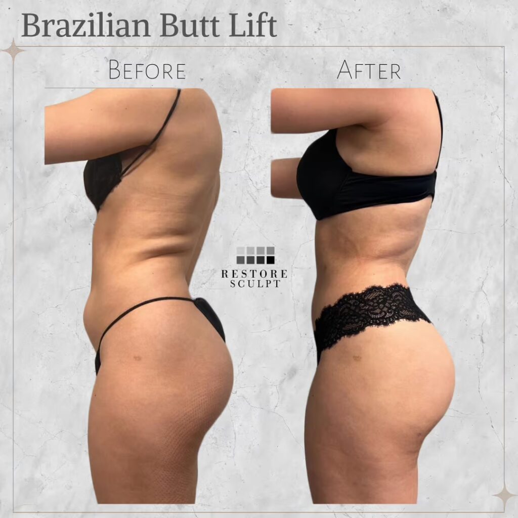Brazilian butt lift before and after, side view, with a rounder buttock contour in the after photo