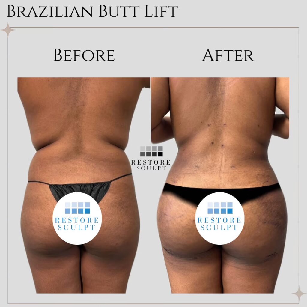 Brazilian butt lift before and after, back view, with more buttock fullness and a slimmer waist in the after photo