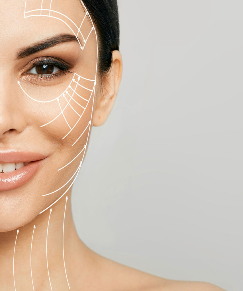Woman's face with lift lines drawn upward along the cheek, jawline, and neck, illustrating how a deep plane facelift repositions the midface, jowls, and neck