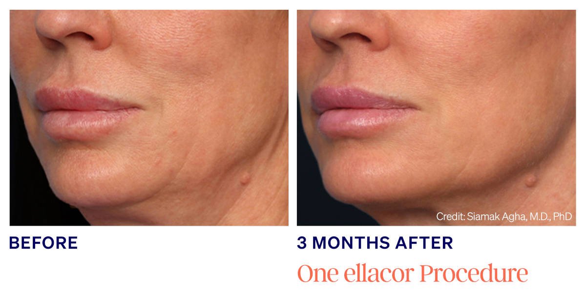 Ellacor micro-coring before and after. 3 Months After 1 ellacor Procedure. Photos courtesy of Siamak Agha, MD, PhD. Manufacturer case from ellacor.com; not a Beyond Restore patient.