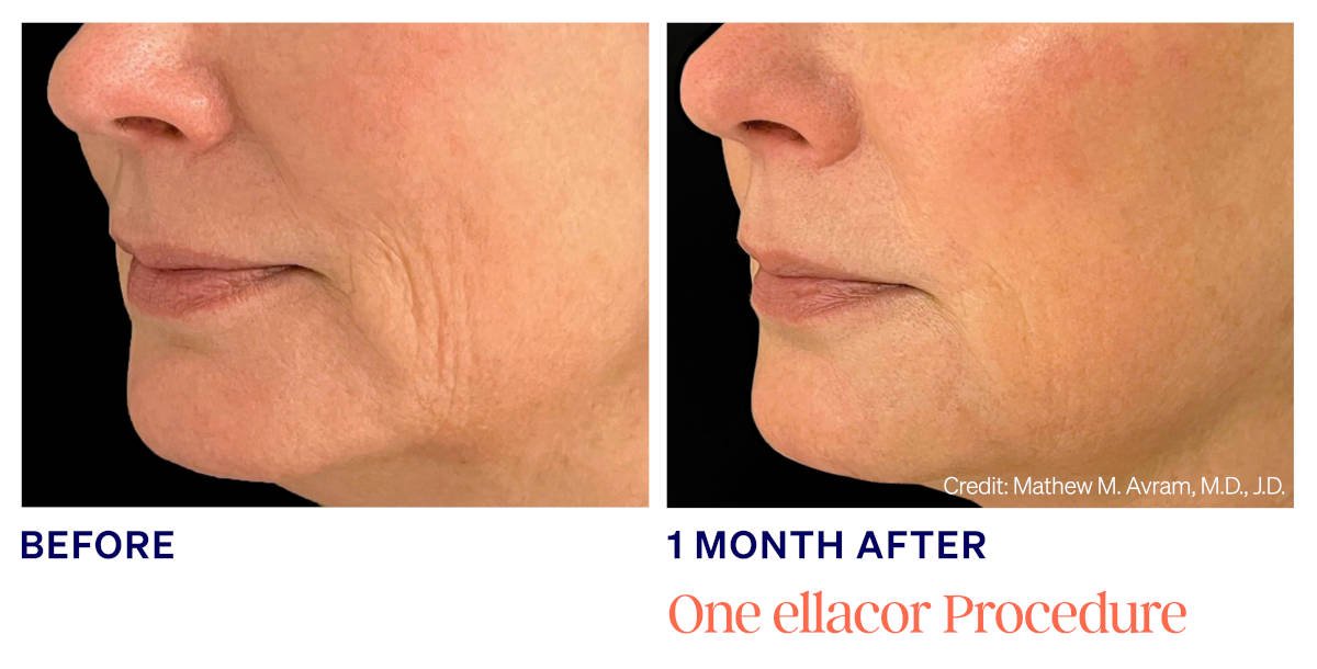 Ellacor micro-coring before and after. 1 Month After 1 ellacor Procedure. Photos courtesy of Mathew M. Avram, MD, JD. Manufacturer case from ellacor.com; not a Beyond Restore patient.