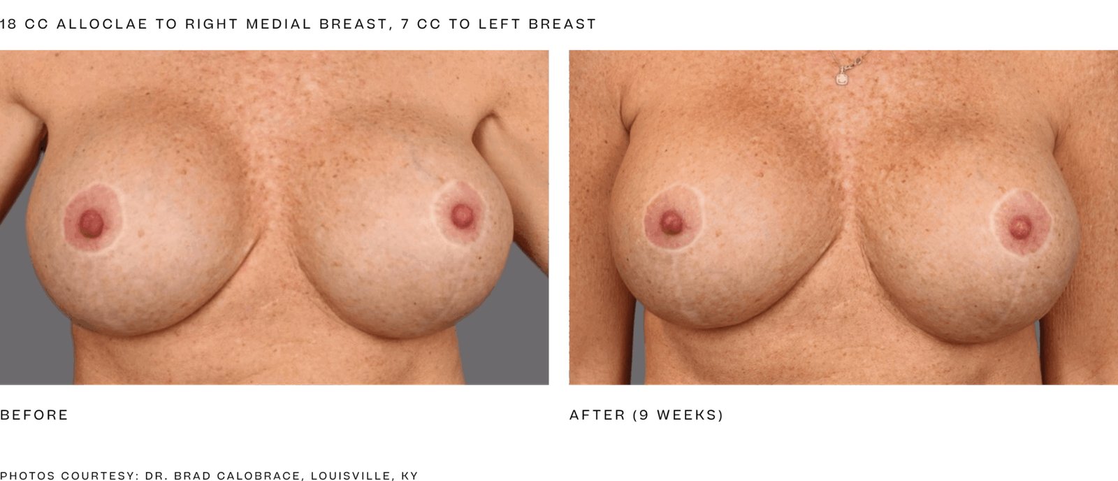 alloClae before and after, breast, 18 cc right medial breast, 7 cc left breast, 9 weeks (manufacturer clinical photo)