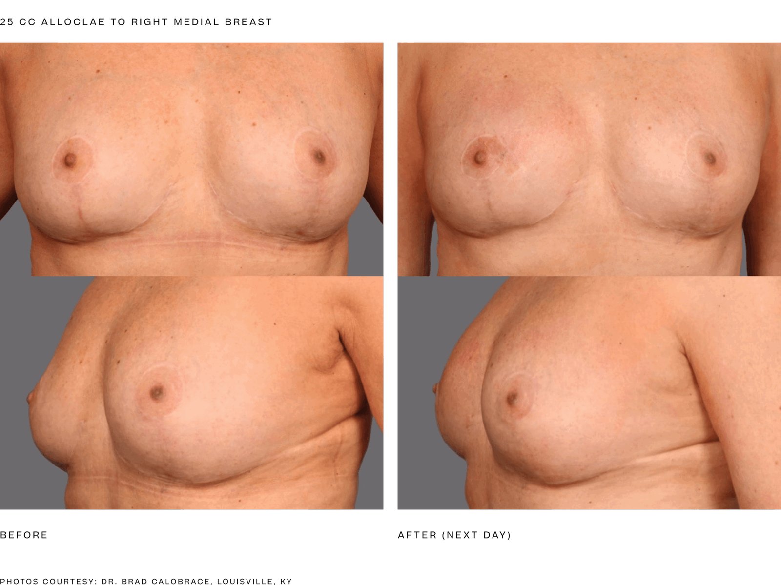 alloClae before and after, breast, 25 cc right medial breast, next day (manufacturer clinical photo)