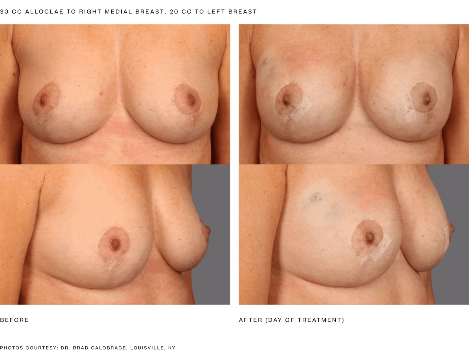 alloClae before and after, breast, 30 cc right medial breast, 20 cc left breast, day of treatment (manufacturer clinical photo)