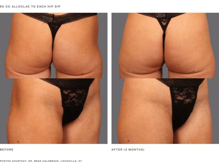 alloClae before and after, 50 cc to each hip dip, 3 months, back and side views. Photos courtesy of Dr. Brad Calobrace, Louisville, KY. Manufacturer case from alloclae.com; not a Beyond Restore patient.
