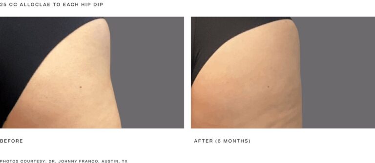 alloClae before and after, 25 cc to each hip dip, 6 months. Photos courtesy of Dr. Johnny Franco, Austin, TX. Manufacturer case from alloclae.com; not a Beyond Restore patient.