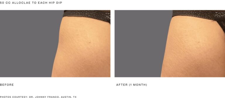 alloClae before and after, 50 cc to each hip dip, 1 month. Photos courtesy of Dr. Johnny Franco, Austin, TX. Manufacturer case from alloclae.com; not a Beyond Restore patient.