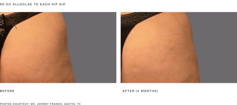 alloClae before and after, 50 cc to each hip dip, 4 months. Photos courtesy of Dr. Johnny Franco, Austin, TX. Manufacturer case from alloclae.com; not a Beyond Restore patient.