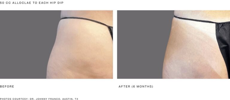 alloClae before and after, 50 cc to each hip dip, 6 months. Photos courtesy of Dr. Johnny Franco, Austin, TX. Manufacturer case from alloclae.com; not a Beyond Restore patient.