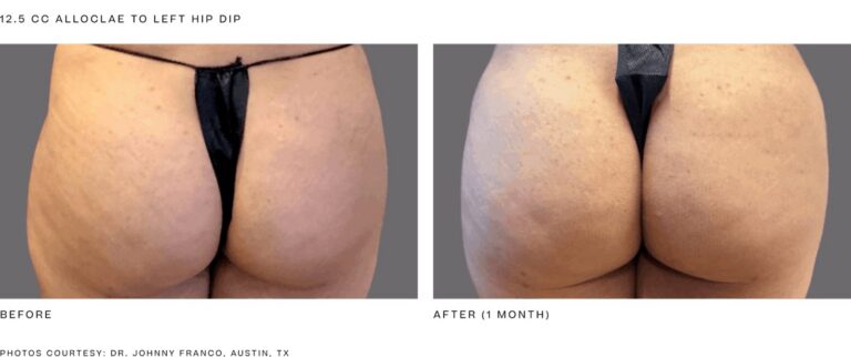 alloClae before and after, 12.5 cc to the left hip dip, 1 month. Photos courtesy of Dr. Johnny Franco, Austin, TX. Manufacturer case from alloclae.com; not a Beyond Restore patient.
