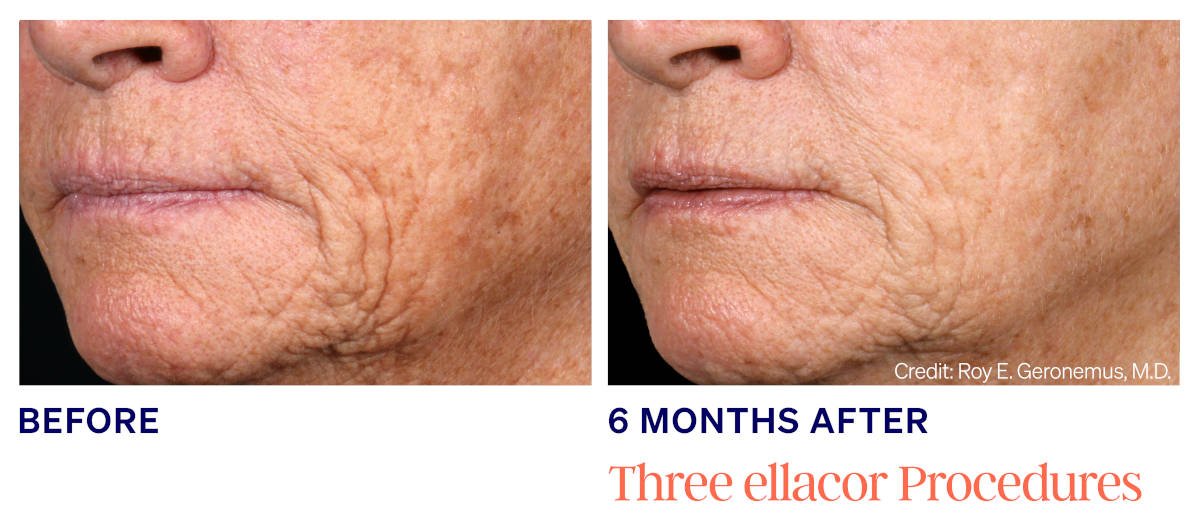 Ellacor micro-coring before and after. Ellacor before and after. Photos courtesy of Roy G. Geronemus, MD. Manufacturer case from ellacor.com; not a Beyond Restore patient.