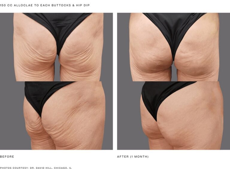 alloClae before and after, 150 cc to each buttock and hip dip, 1 month, back and oblique views. Photos courtesy of Dr. David Hill, Chicago, IL. Manufacturer case from alloclae.com; not a Beyond Restore patient.