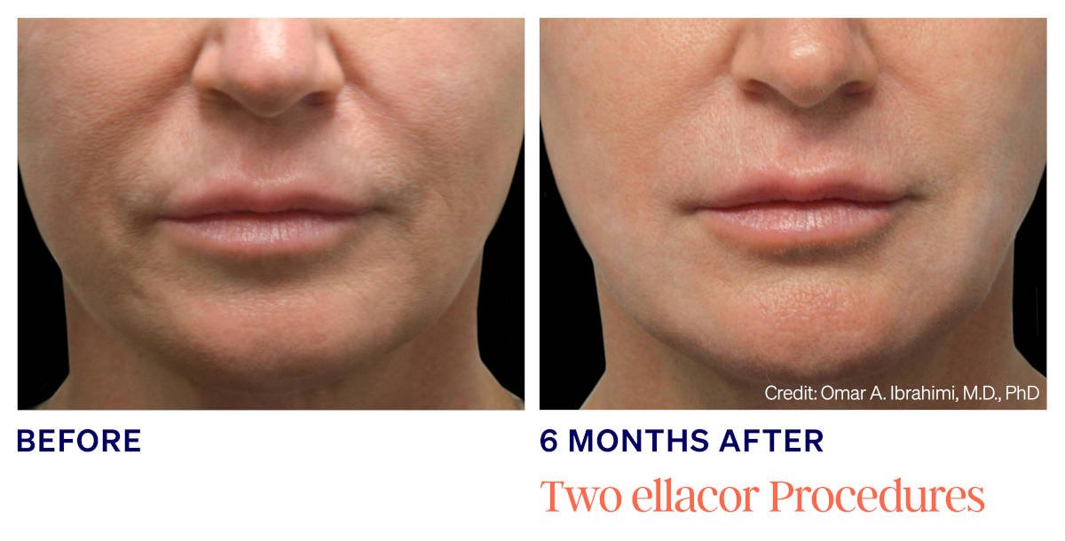 Ellacor micro-coring before and after. 6 Months After 2 ellacor Procedures. Photos courtesy of Omar A. Ibrahimi, MD, PhD. Manufacturer case from ellacor.com; not a Beyond Restore patient.