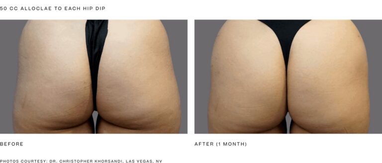 alloClae before and after, 50 cc to each hip dip, 1 month. Photos courtesy of Dr. Christopher Khorsandi, Las Vegas, NV. Manufacturer case from alloclae.com; not a Beyond Restore patient.