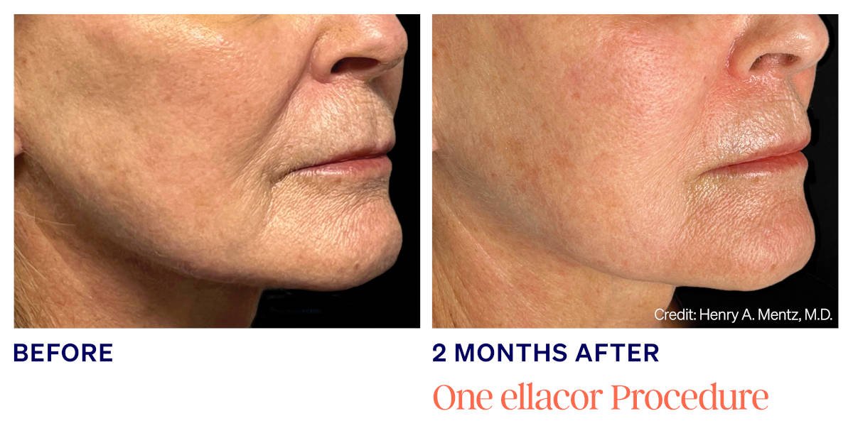 Ellacor micro-coring before and after. 2 Months After 1 ellacor Procedure. Photos courtesy of Henry A. Mentz, MD. Manufacturer case from ellacor.com; not a Beyond Restore patient.