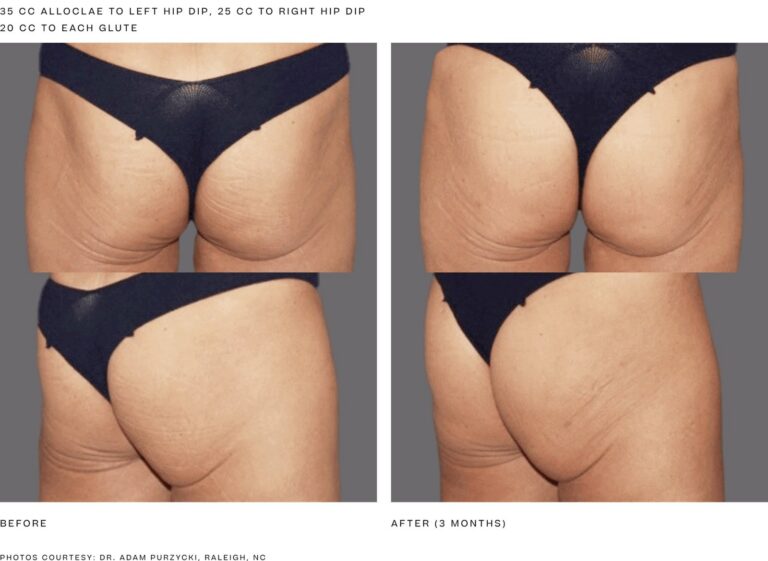 alloClae before and after, 35 cc to the left hip dip, 25 cc to the right hip dip and 20 cc to each glute, 3 months. Photos courtesy of Dr. Adam Purzycki, Raleigh, NC. Manufacturer case from alloclae.com; not a Beyond Restore patient.