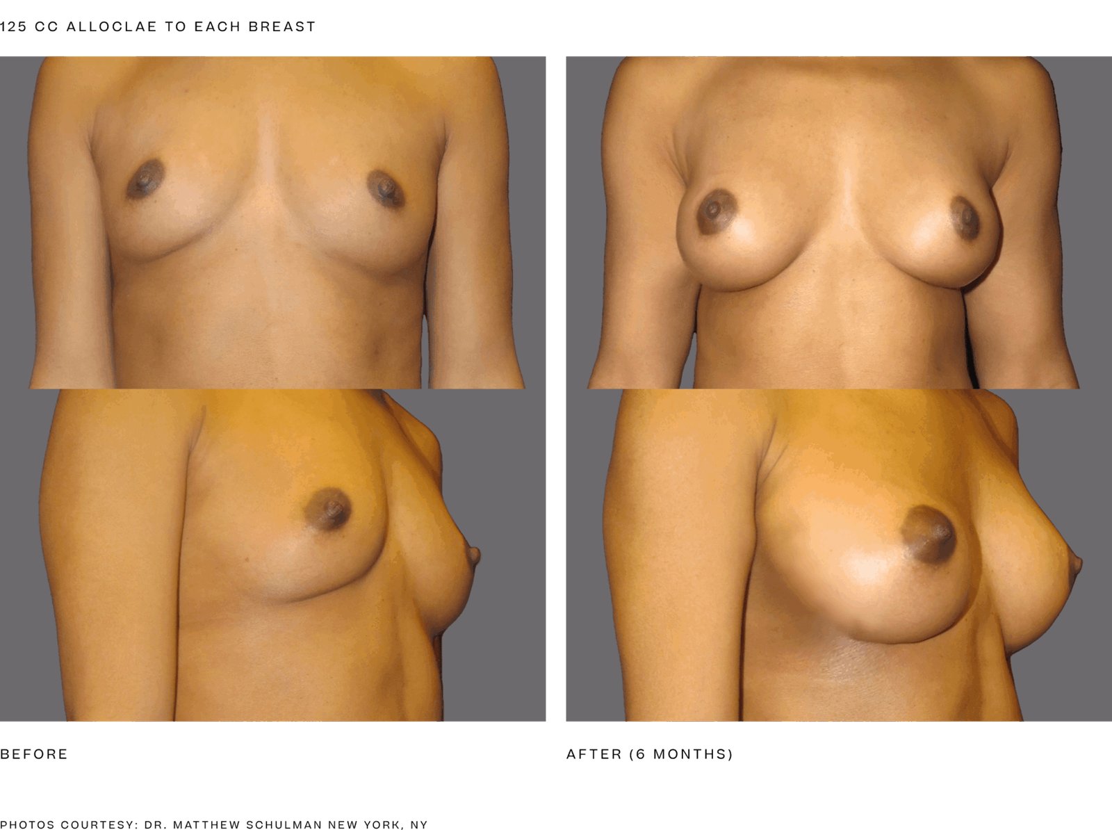 alloClae before and after, breast, 125 cc to each breast, 6 months (manufacturer clinical photo)