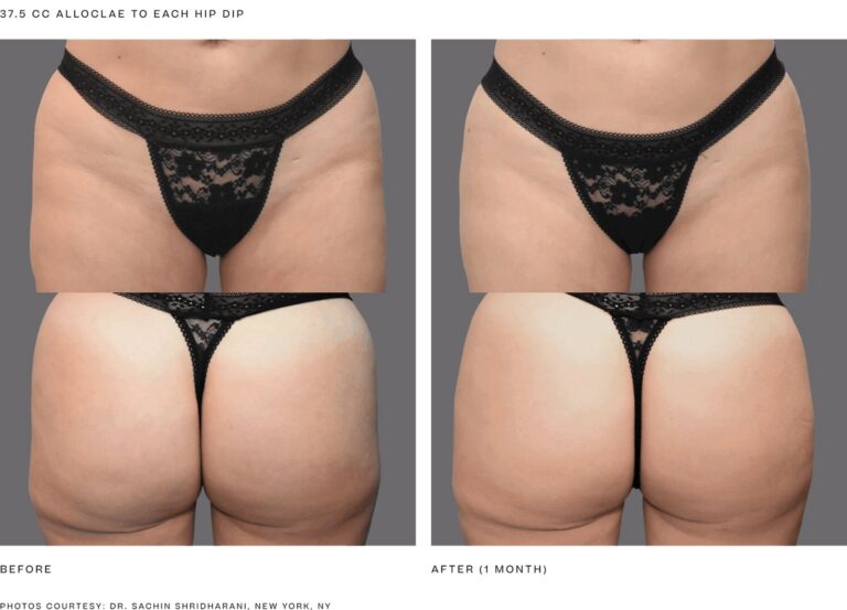 alloClae before and after, 37.5 cc to each hip dip, 1 month, front and back views. Photos courtesy of Dr. Sachin Shridharani, New York, NY. Manufacturer case from alloclae.com; not a Beyond Restore patient.
