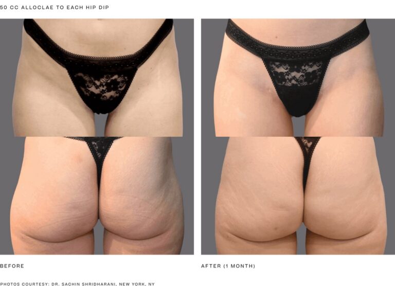 alloClae before and after, 50 cc to each hip dip, 1 month. Photos courtesy of Dr. Sachin Shridharani, New York, NY. Manufacturer case from alloclae.com; not a Beyond Restore patient.