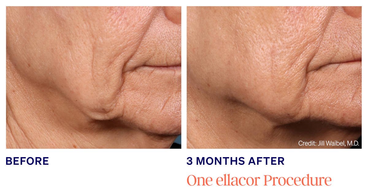 Ellacor micro-coring before and after. 3 Months After 1 ellacor Procedure. Photos courtesy of Jill Waibel, MD. Manufacturer case from ellacor.com; not a Beyond Restore patient.
