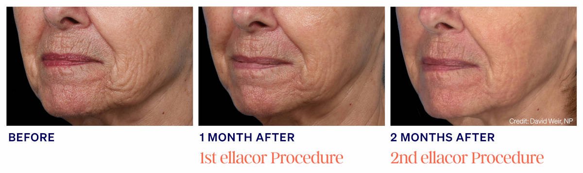 Ellacor micro-coring before and after. 2 Months After 2 ellacor Procedures. Photos courtesy of David Weir, NP. Manufacturer case from ellacor.com; not a Beyond Restore patient.