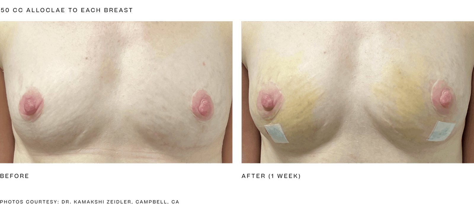 alloClae before and after, breast, 50 cc to each breast, 1 week (manufacturer clinical photo)