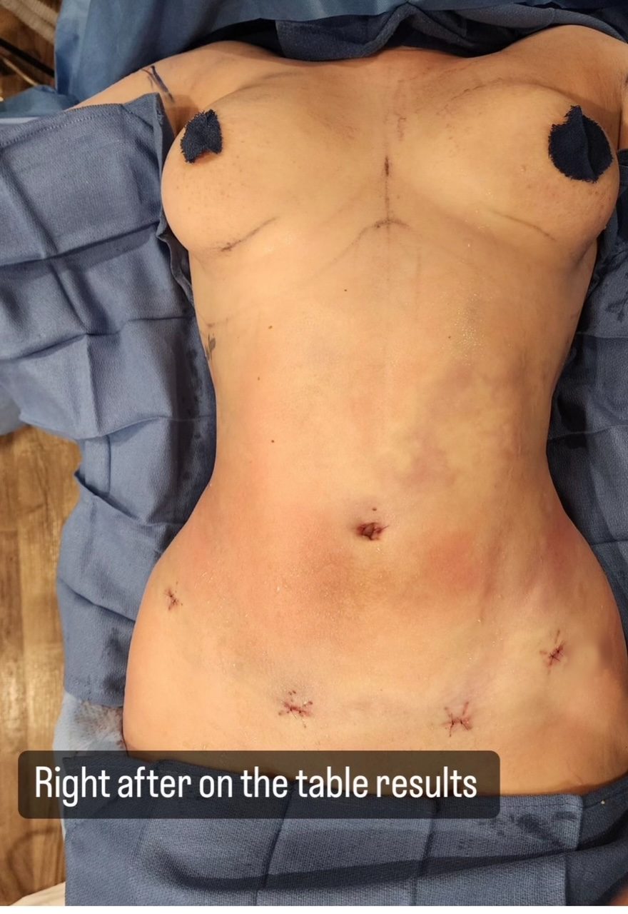 Abdomen immediately after HD liposuction on the operating table, with incision sites, swelling, and bruising visible, Beyond Restore Newport Beach