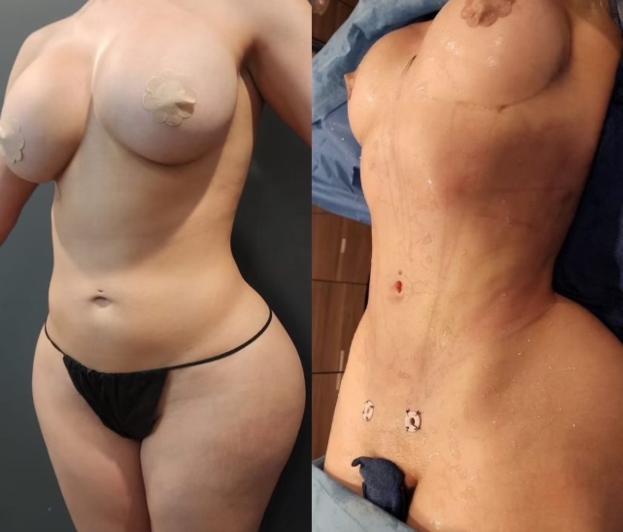 Side-by-side clinical comparison of torso before HD liposuction and immediately after surgery on the operating table, Beyond Restore Newport Beach