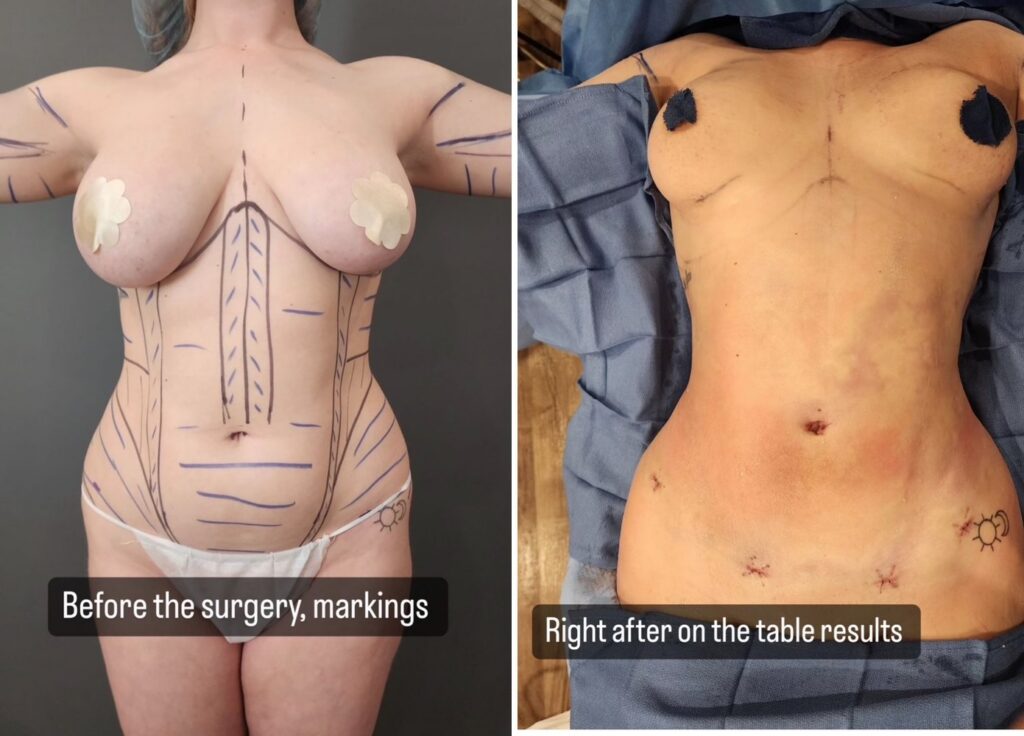 HD Liposculpture before and after, front view: surgical markings before surgery and results right after surgery.
