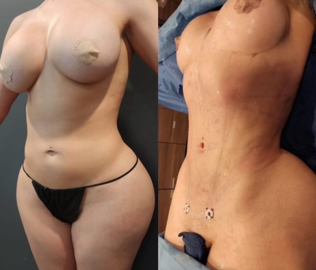 HD Liposculpture result, oblique view, Beyond Restore patient.