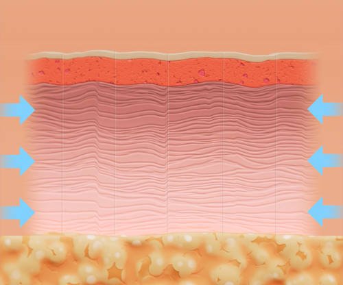 Still from Ellacor mechanism of action showing micro-coring from ellacor.com