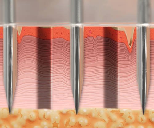 Illustration of Ellacor hollow-needle micro-coring procedure from ellacor.com