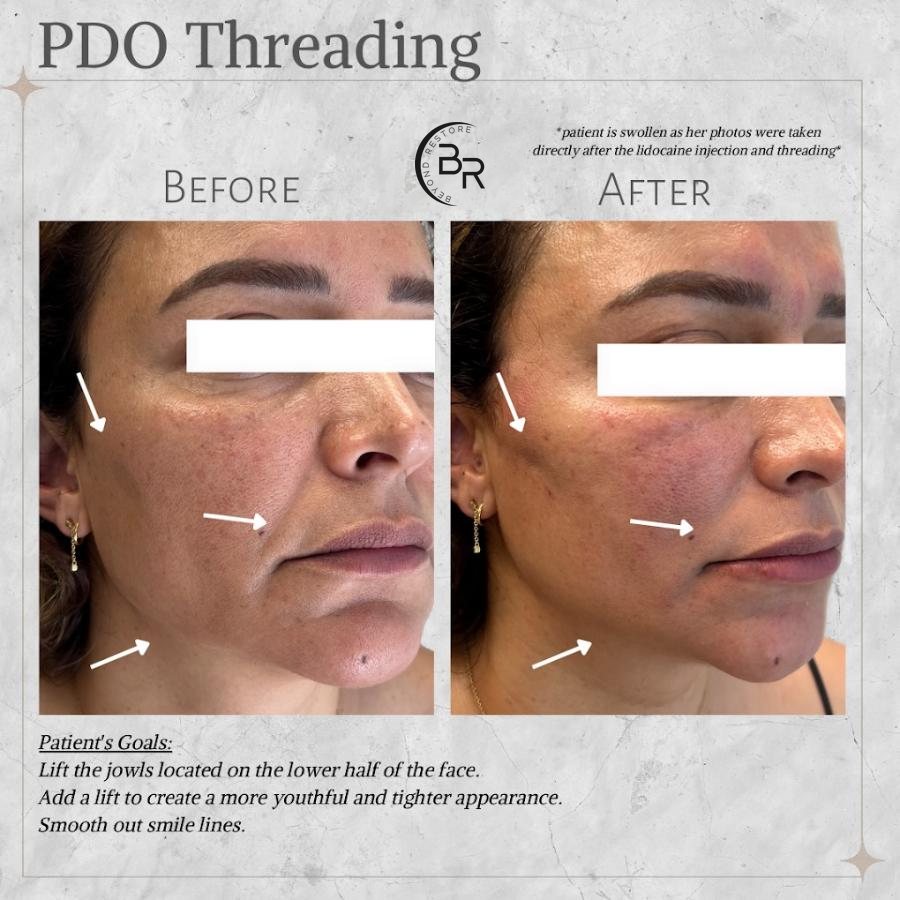 Side-view before and after photos of a woman's lower face and jawline with arrows at the cheek, smile line and jaw, under the heading PDO Threading and the Beyond Restore logo