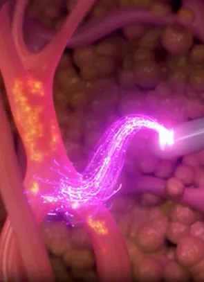 Illustration of a Renuvion helium plasma wand beneath the skin
