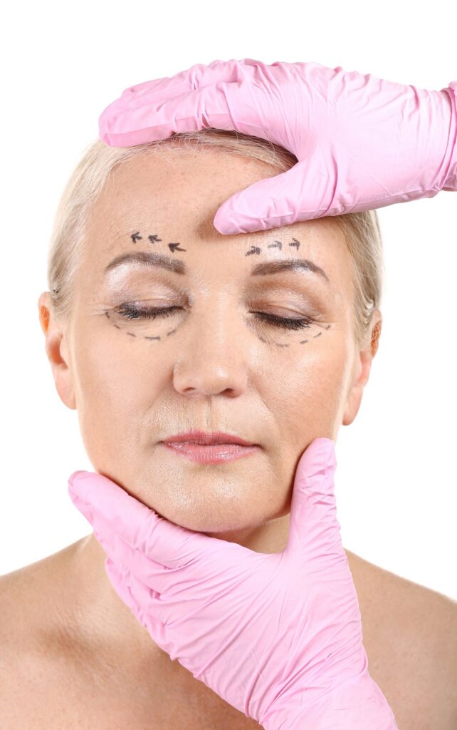 Surgeon's gloved hands with pre-op markings on a mature woman's face
